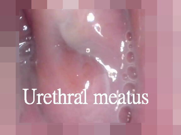 2入院患者・Urethral meatus